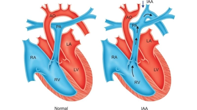 Interrupted aortic arch surgery procedures and outcomes
