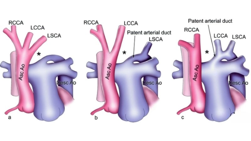Interrupted aortic arch diagnosis methods and imaging