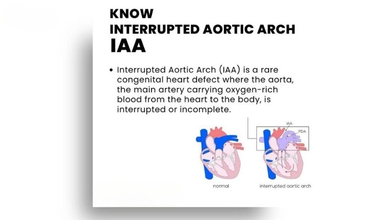 Interrupted aortic arch life expectancy survival outlook