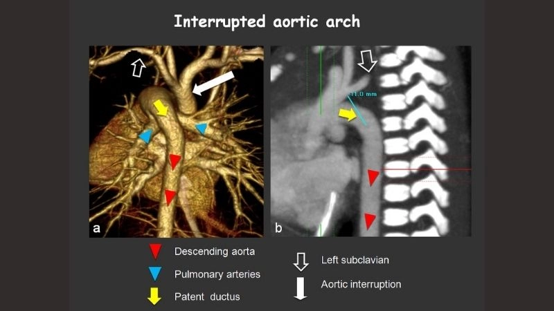 Interrupted aortic arch vs coarctation key differences