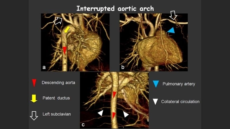 Interrupted aortic arch repair techniques and recovery