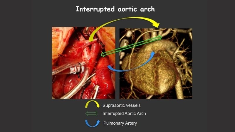 Interrupted aortic arch newborn care and management
