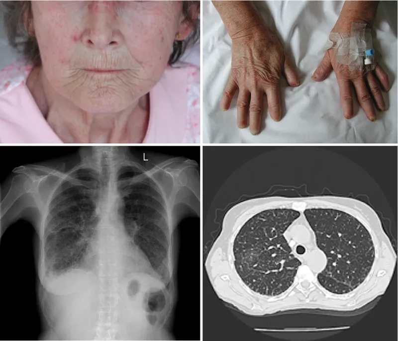 Factors influencing interstitial lung disease life expectancy