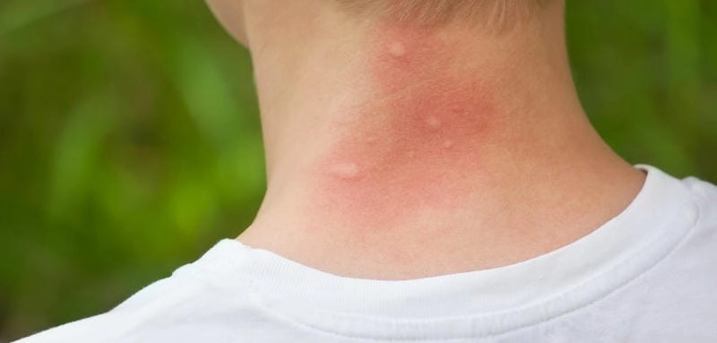 Japanese Encephalitis vaccine protects you fast