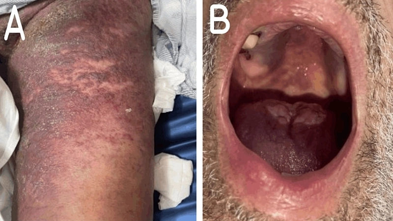 Kaposi's Sarcoma caused by KSHV
