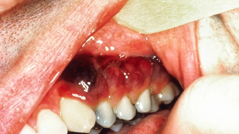 Kaposi's Sarcoma shows skin lesions