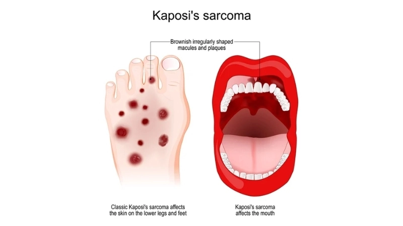 Kaposi's Sarcoma from immunosuppression