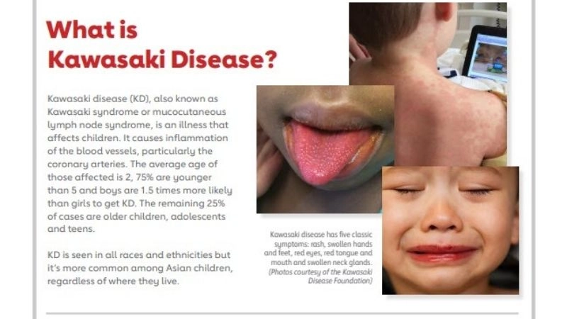 Kawasaki disease symptoms that parents must know