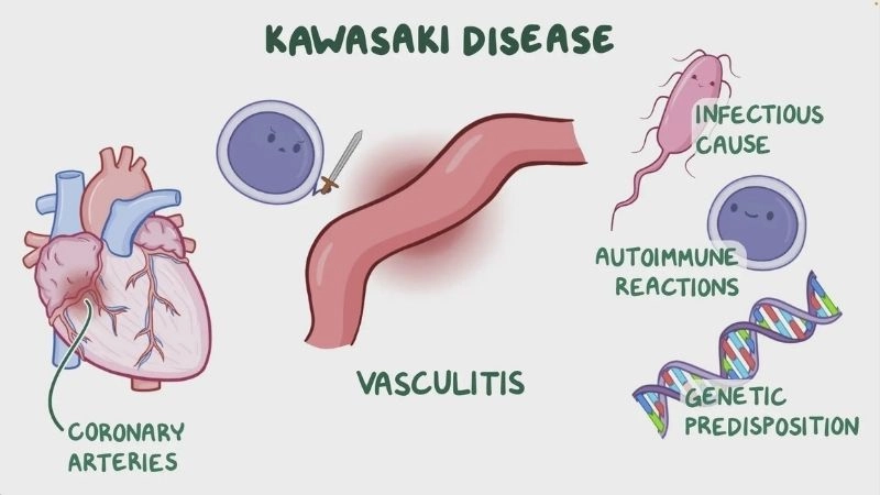 Kawasaki disease treatment options for children