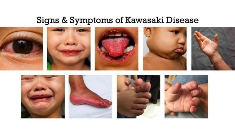 Kawasaki disease rash as a common early sign