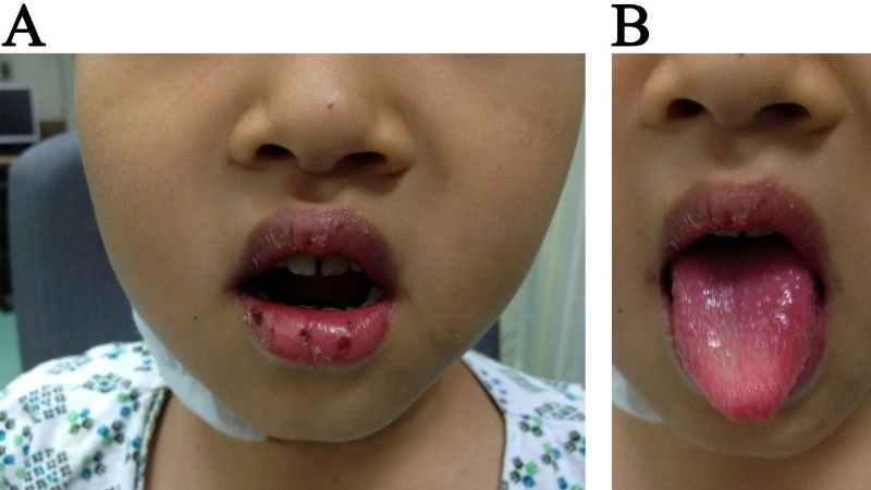 Kawasaki disease causes and possible triggers