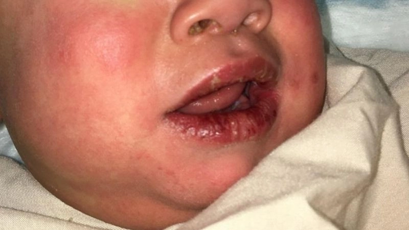 Kawasaki disease long term effects on health