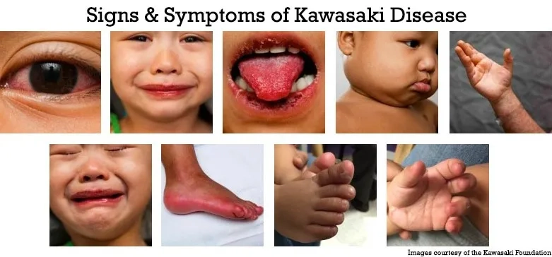 Close-up of a strawberry tongue from Kawasaki disease