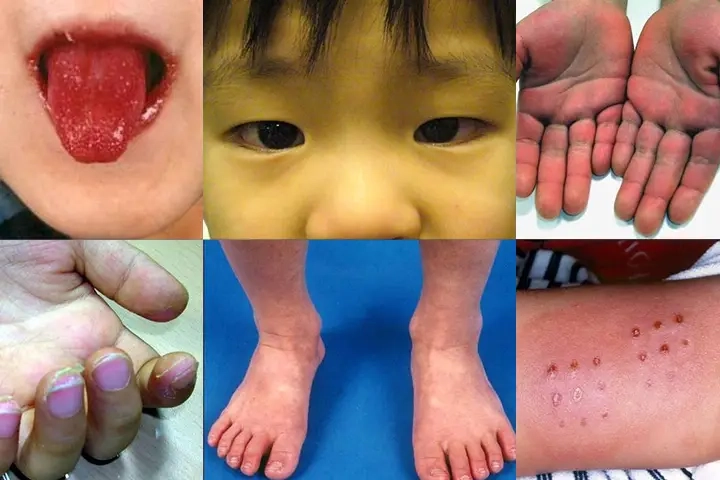 Recognizing Kawasaki disease symptoms in toddlers