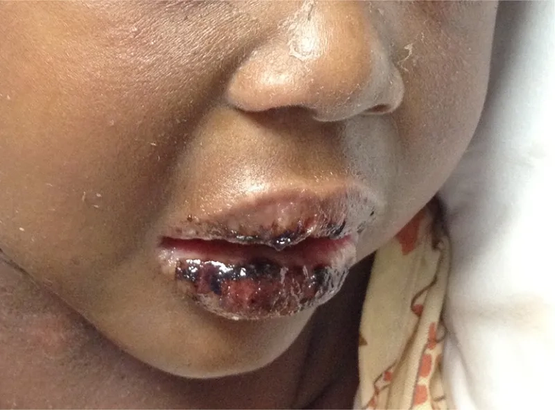 Fact sheet on is Kawasaki disease contagious