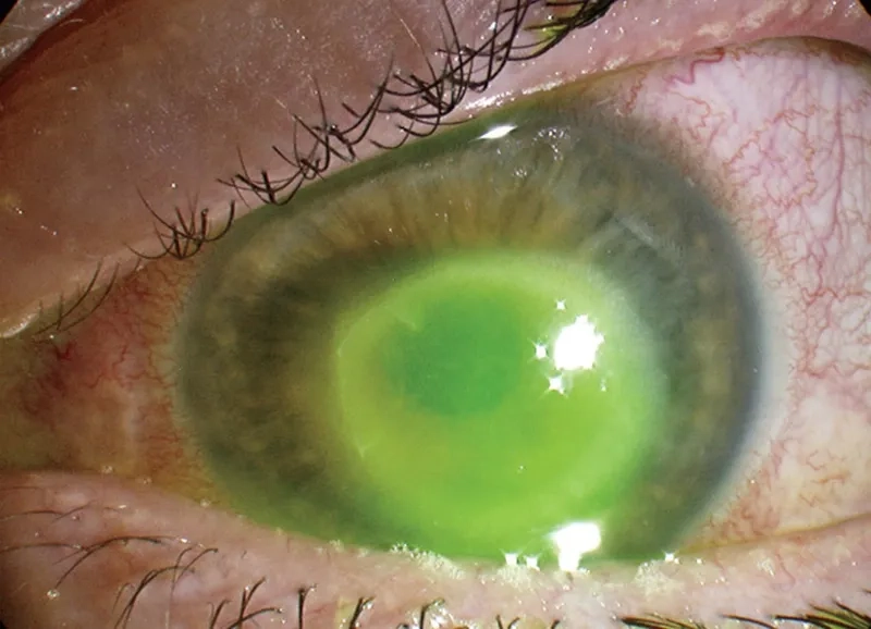 Diagram illustrating the different types of keratitis