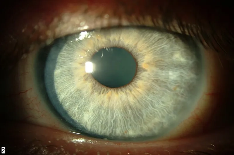 The distinct appearance of herpes simplex keratitis