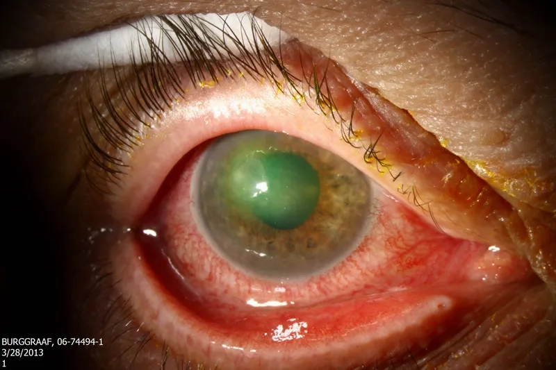 Acanthamoeba keratitis risk from contact lenses
