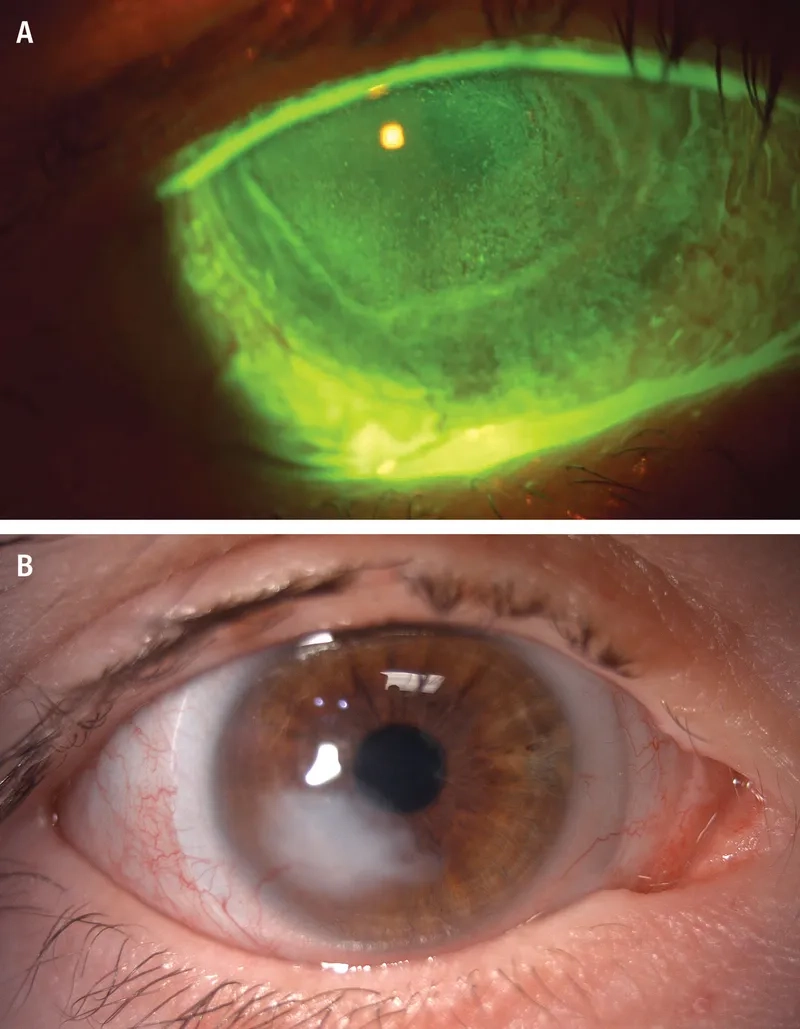 Comparing a corneal ulcer vs keratitis in the eye