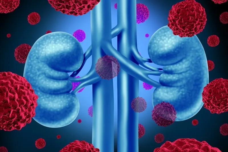 Kidney Cancer Survival Rate by Stage