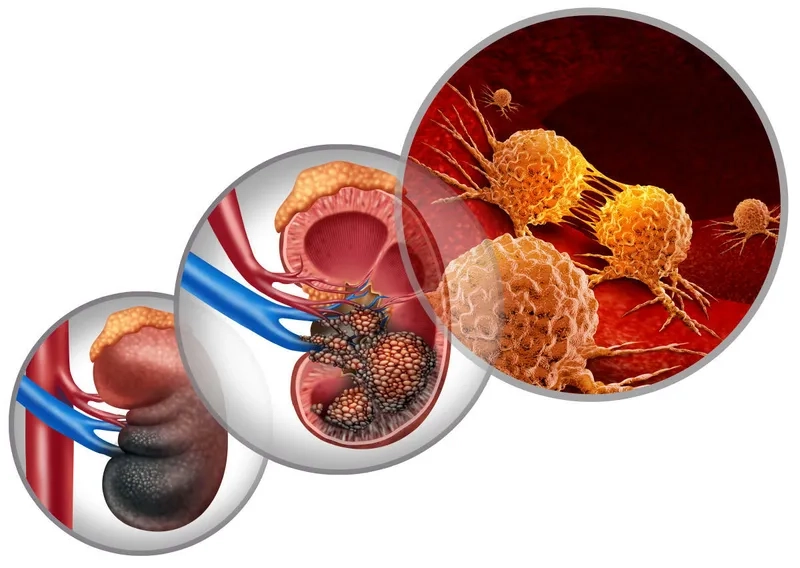 Effective Kidney Cancer Treatment Options