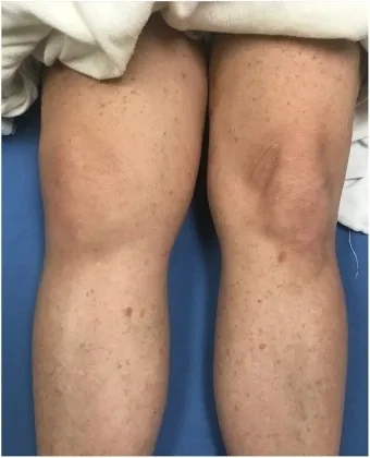 Detecting Kingella kingae in a blood culture