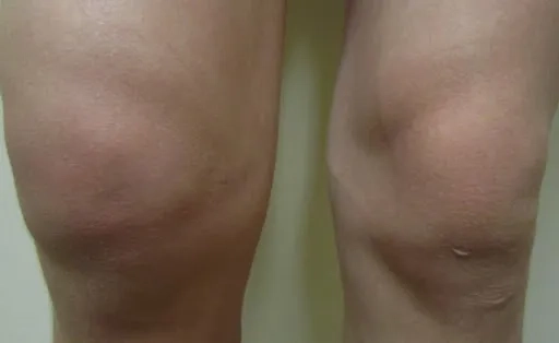 Understanding how Kingella kingae is transmitted