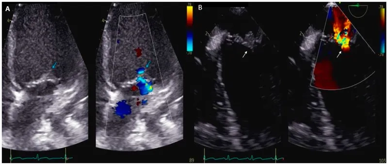 Identifying Kingella kingae symptoms in toddlers