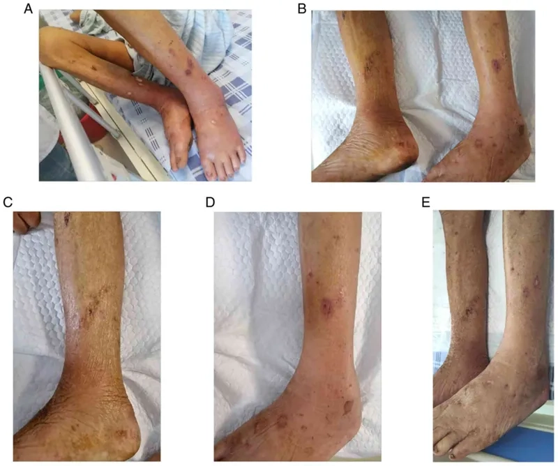 Illustration of a Klebsiella pneumoniae UTI