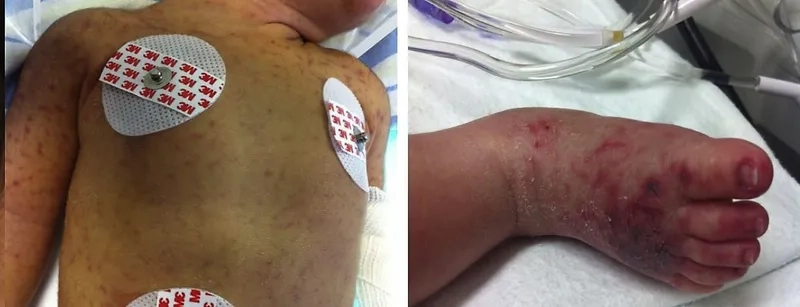 Micrograph of carbapenem-resistant Klebsiella pneumoniae