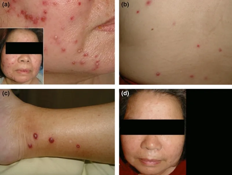Chest X-ray of Klebsiella pneumoniae pneumonia