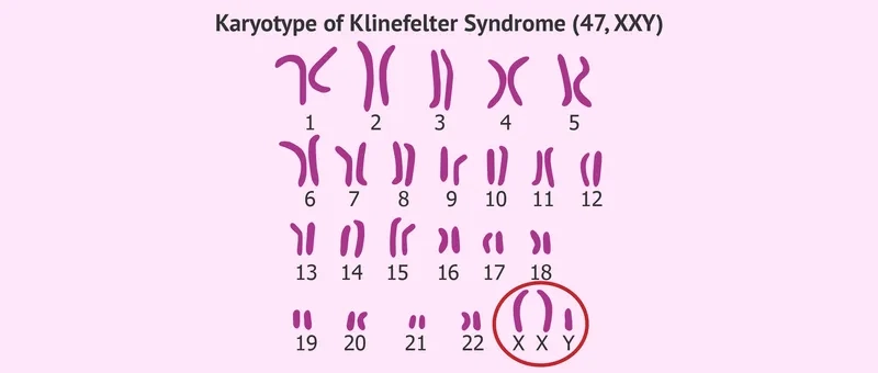 47 xxy chromosomal pattern and health implications