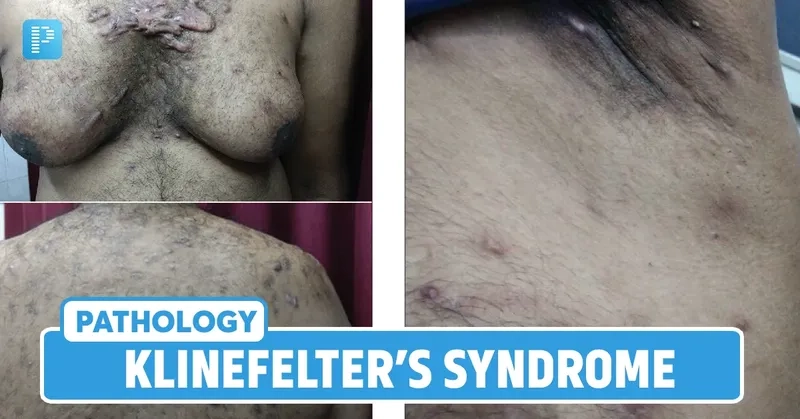 What is klinefelter syndrome and medical overview