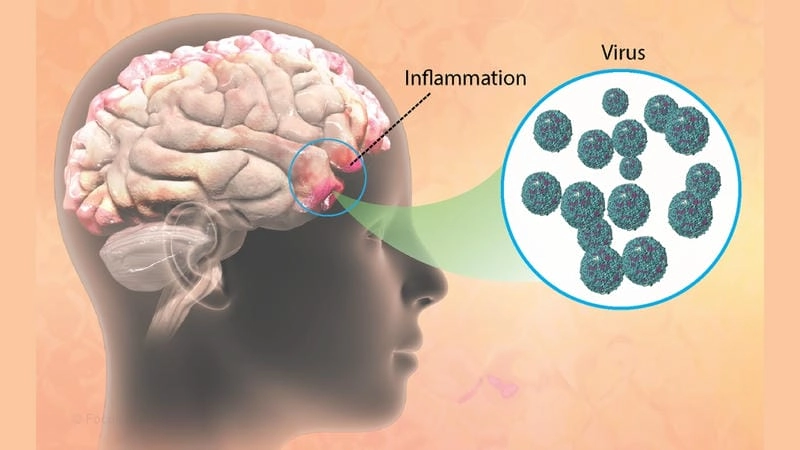 Learn early signs of encephalitis in children