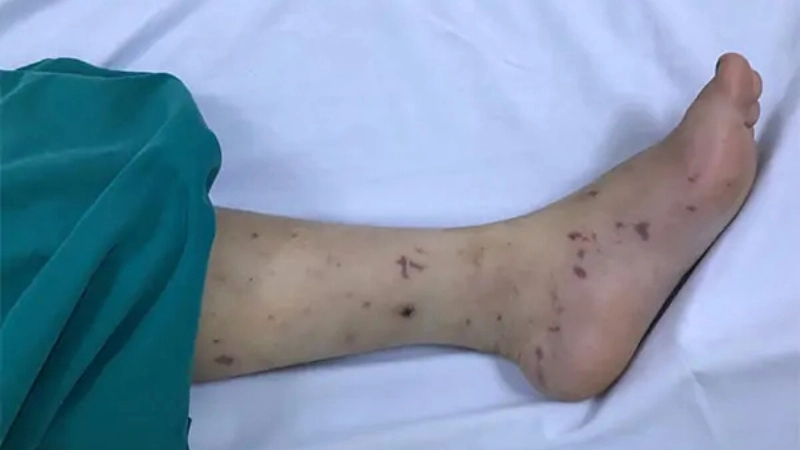 Avoid vector-borne disease with proper precautions