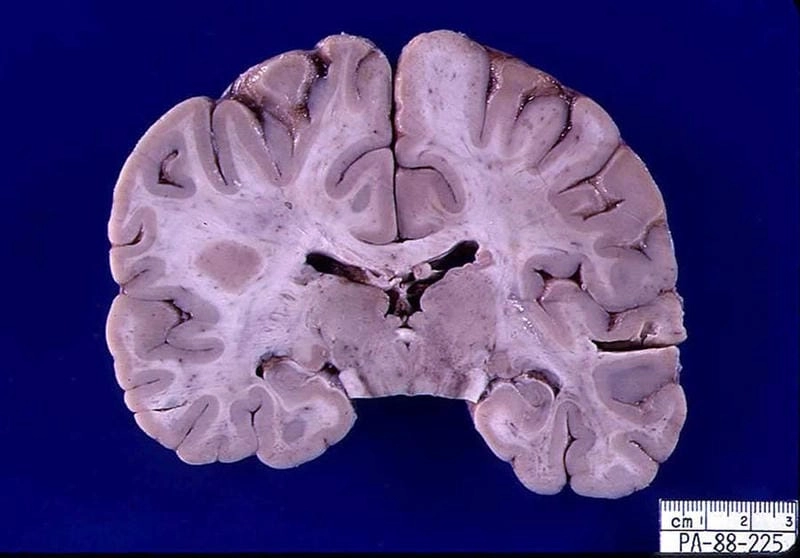 Quick diagnosis helps treat La Crosse encephalitis