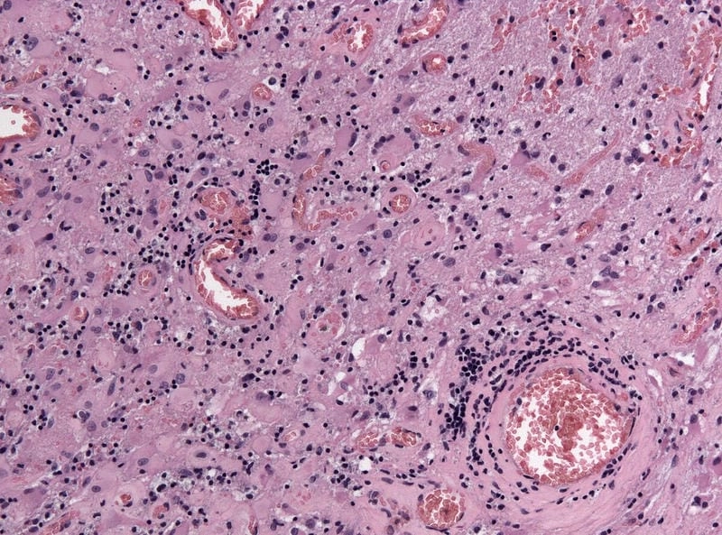 Protect yourself from mosquitoborne illness today