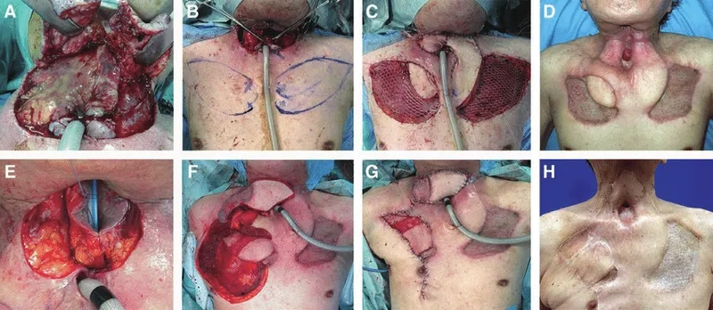 Identifying throat cancer symptoms for timely intervention