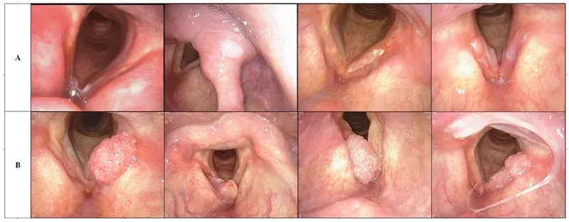 Investigating causes of laryngeal cancer risks