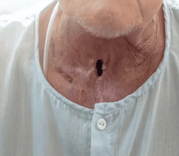 Understanding laryngeal cancer stages and progression