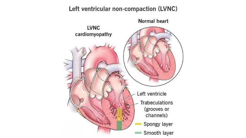LVNC symptoms include fatigue and palpitations