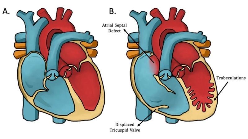 Left Ventricular Non-Compaction Cardiomyopathy treatment includes meds and surgery