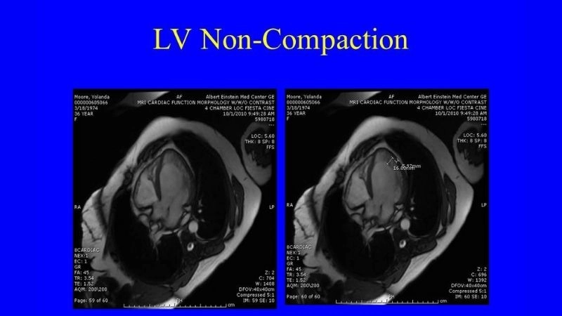 Causes of Left Ventricular Non-Compaction often linked to gene mutations