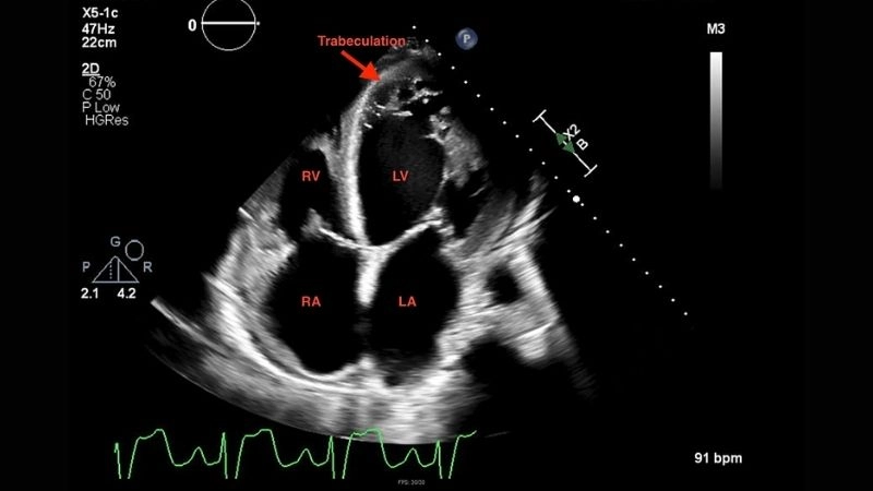 Left Ventricular Non-Compaction and heart failure often progress together