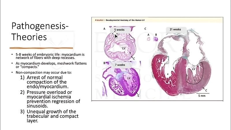 Left Ventricular Non-Compaction and arrhythmia raise sudden death risk