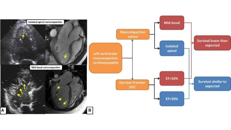 Left Ventricular Non-Compaction patient stories share real experiences