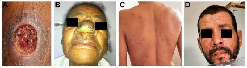 The vector responsible for a Leishmaniasis sandfly bite