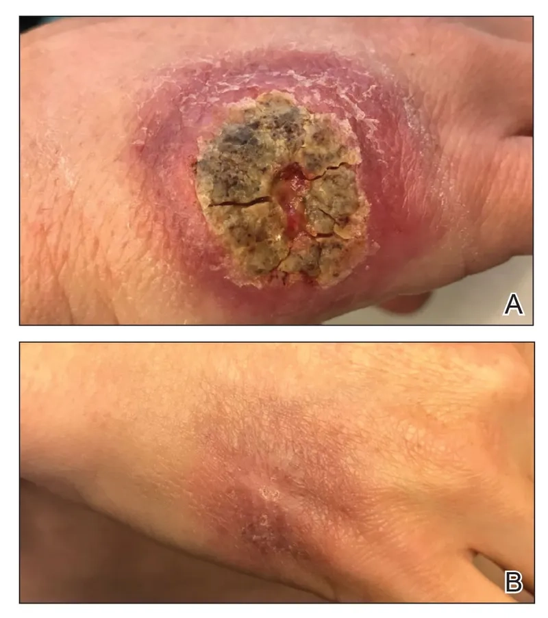 A typical skin ulcer caused by cutaneous Leishmaniasis