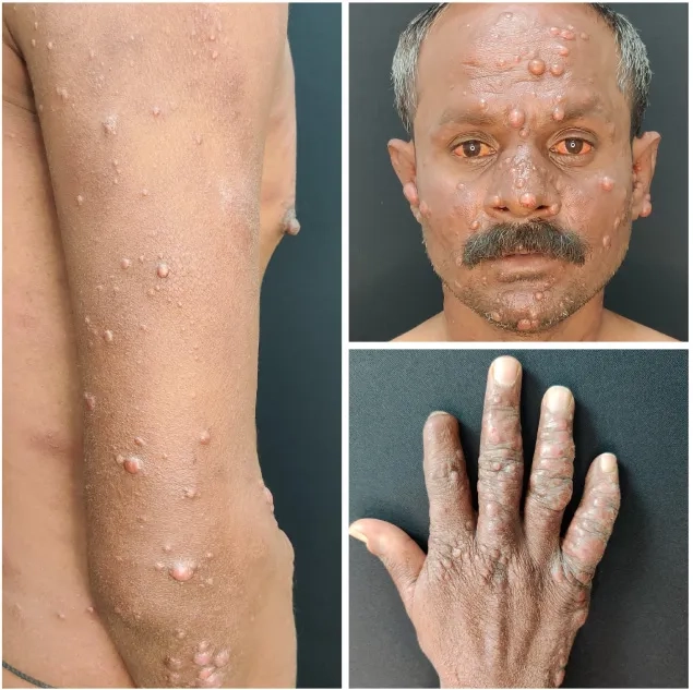 Is leprosy contagious? Understanding transmission
