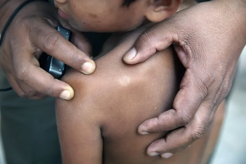 An explanation of what is Hansen's disease